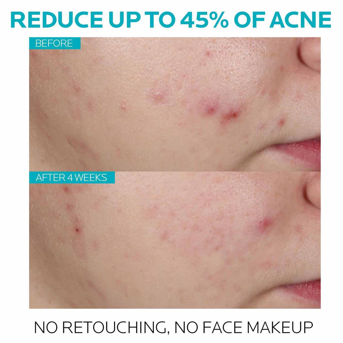 effaclar-salicylic-acid-acne-treatment-serum-e6 7_EffaclarSerum_After-45-days.jpg