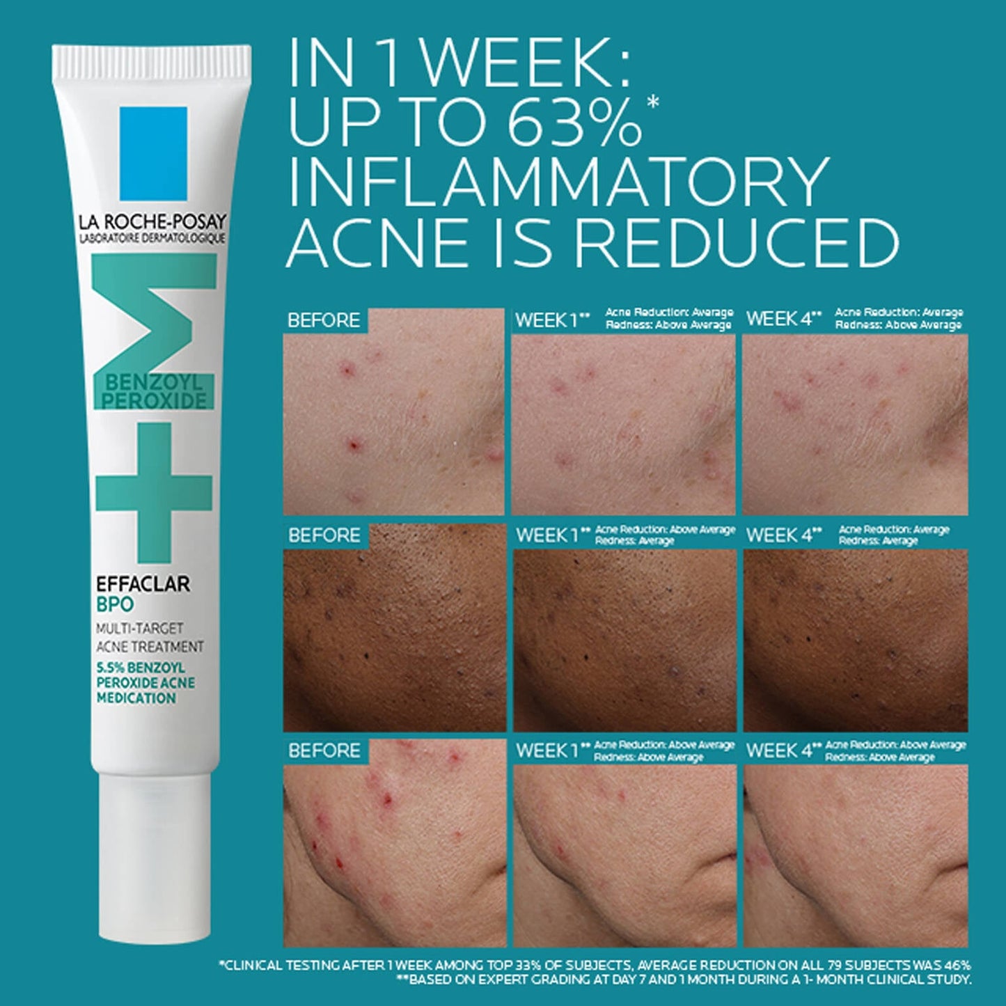 effaclar-bpo-multi-target-acne-treatment-with-5-5-benzoyl-peroxide-x5 EffaclarBPO-ClinicalBA-ATF-1500x1500-2.jpg