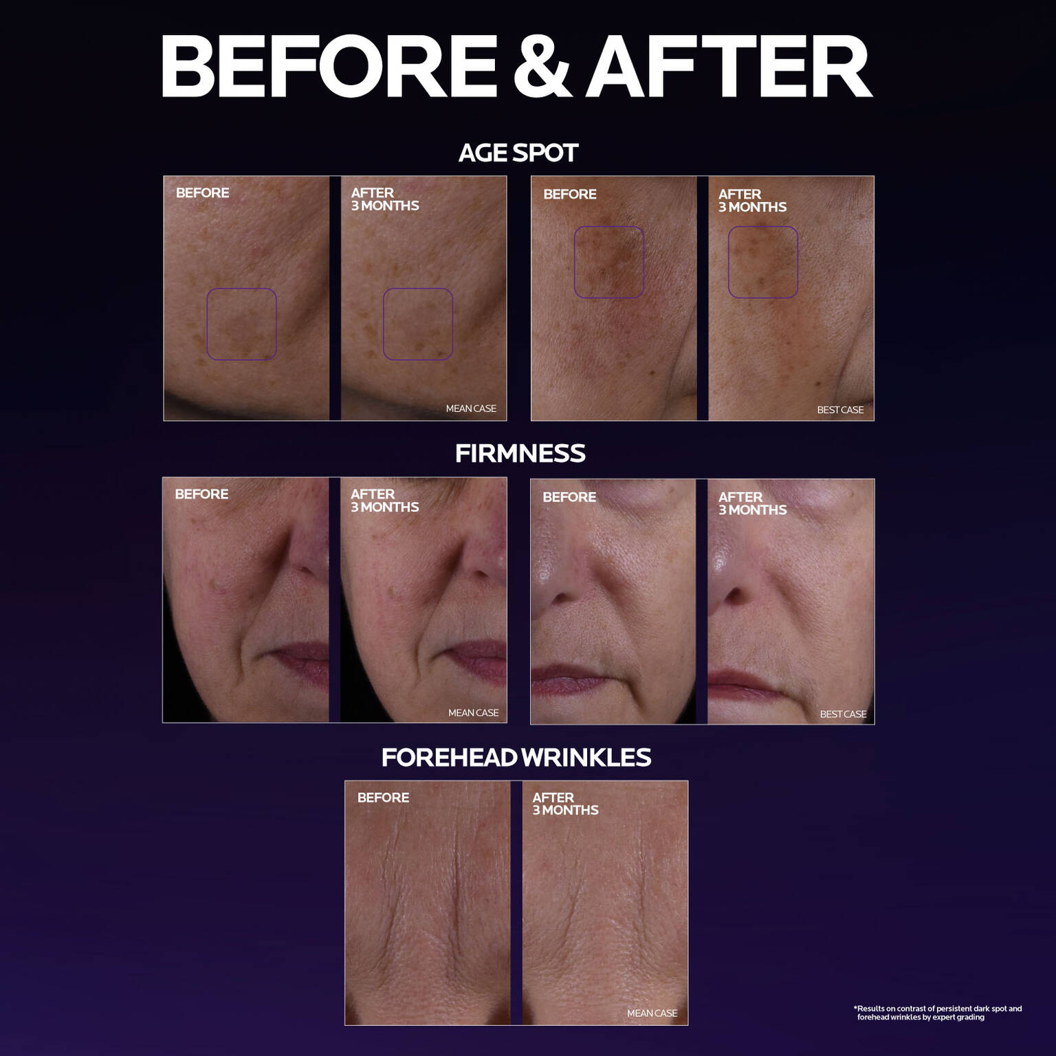 mela-b3-double-dose-discoloration-treatment-with-melasyltm-o2 MelaB3_DD_BTF_BeforeAfter_1500x1500_5.jpg